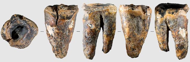 Dente em caverna da Sibéria revela cirurgia dentária em neandertal