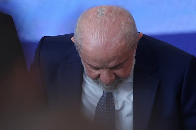 Lesão retirada da cabeça de Lula é câncer de pele em estágio inicial e presidente passa por radioterapia preventiva